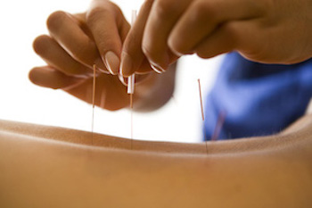 Fairview Chiropractic Centre acupuncture